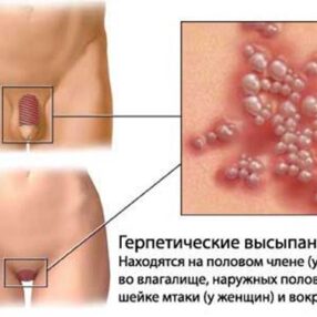 Виды заболеваний: сыпь на головке