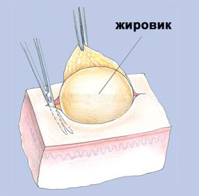 Опасны ли жировики на члене?